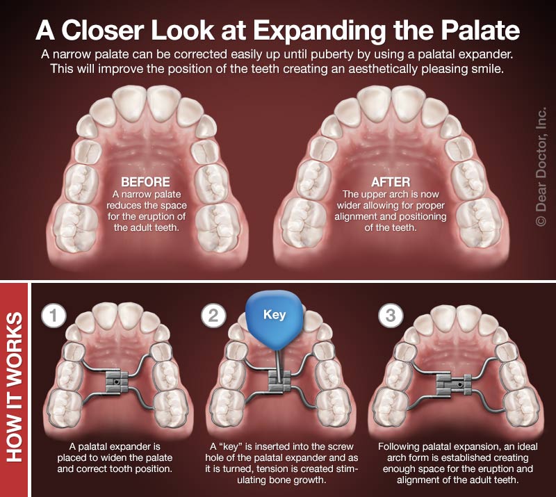 Palatal Expanders, Mairead M. O'Reilly, DDS, MS