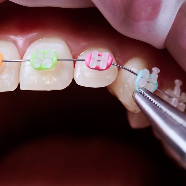 Rubber Band Wear - Orthodontist Vancouver WA, Braces and Invisalign