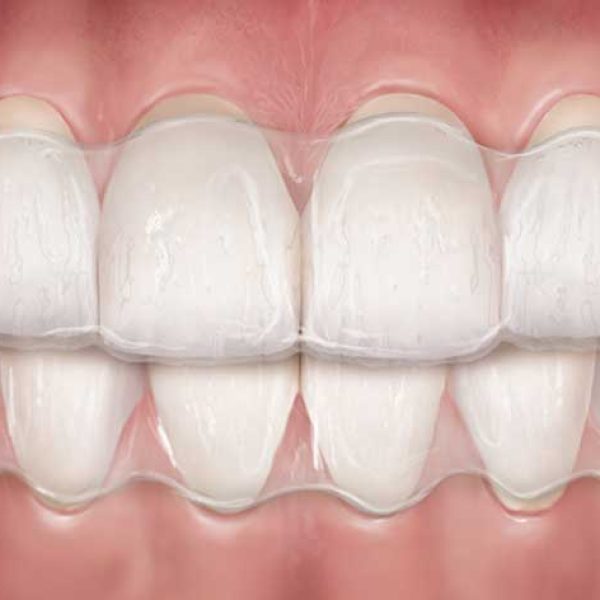 clear-aligners