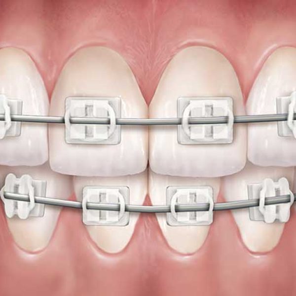 clear-braces clear-braces