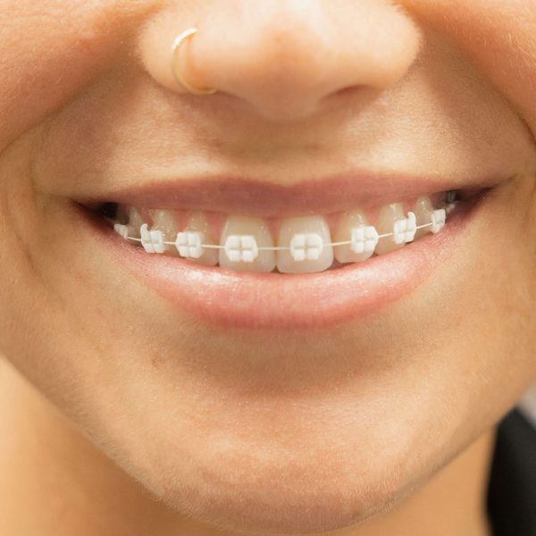 lightforce-braces lightforce-braces