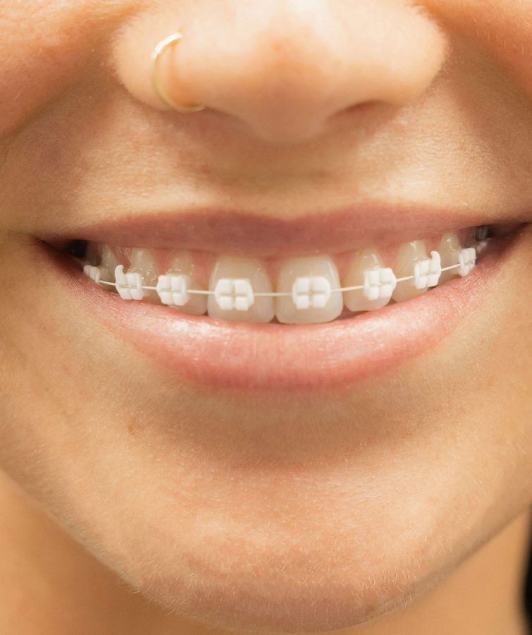 lightforce-braces lightforce-braces