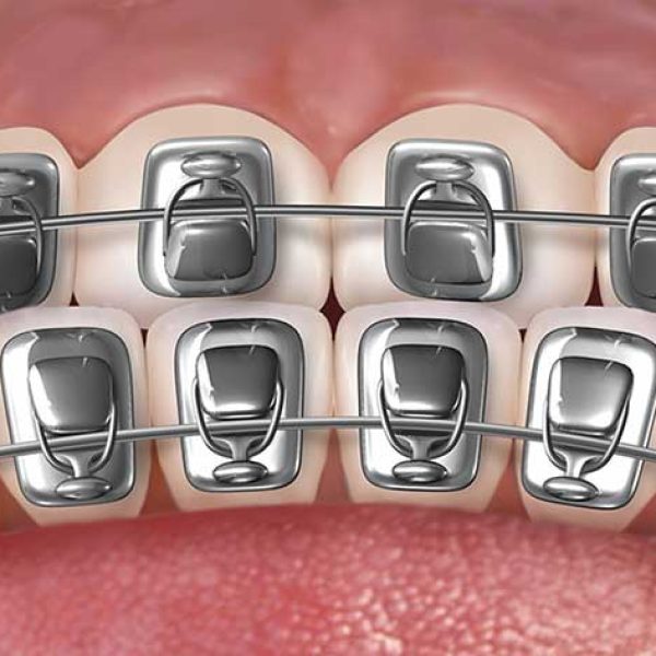 lingual-braces lingual-braces
