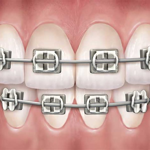 metal-braces