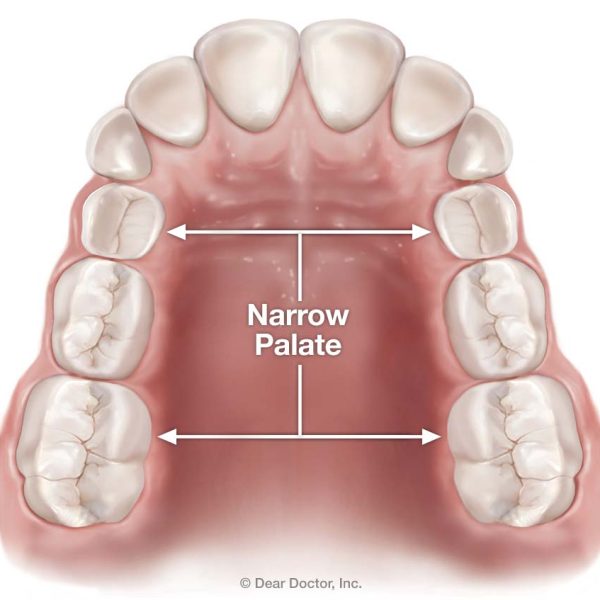 narrow-palate narrow-palate