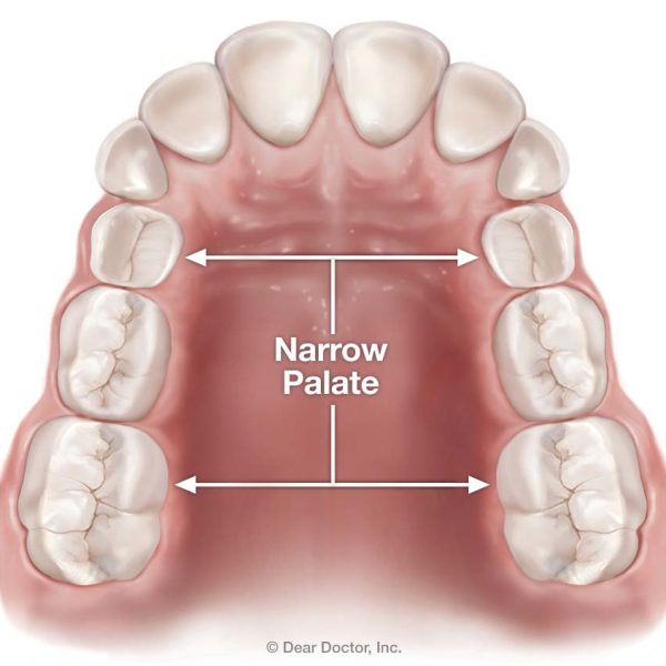 narrow-palate